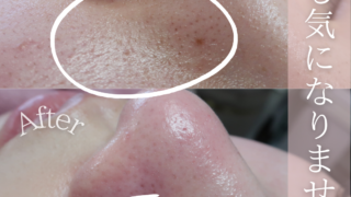 鼻から頬にかけての毛穴もキレイになります。 - フェイシャルエステ