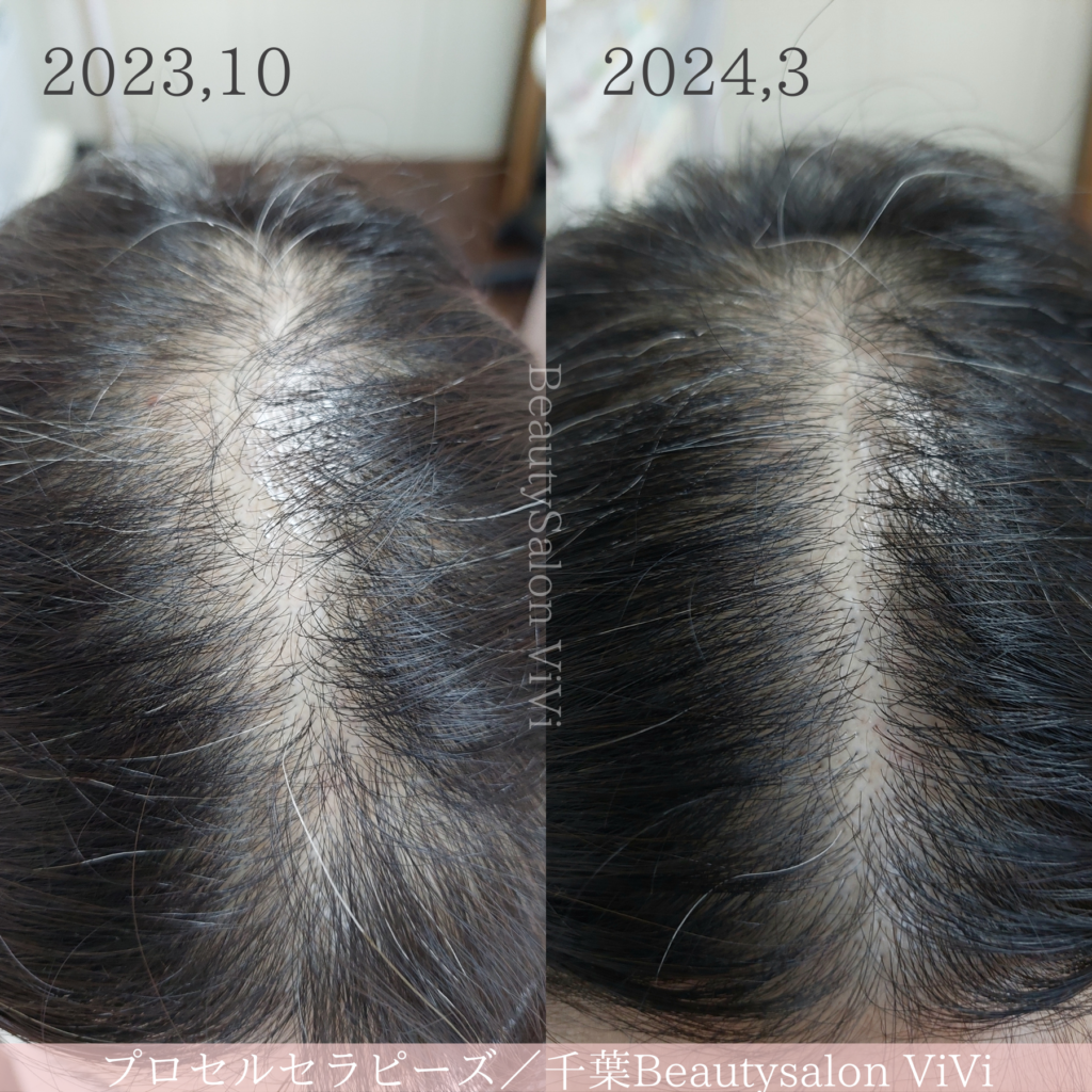 プロセル頭皮トリートメントの経過 - フェイシャルエステ・毛穴洗浄