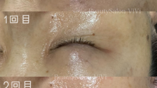 最初は週1で5回継続してほしい理由 - フェイシャルエステ・毛穴洗浄