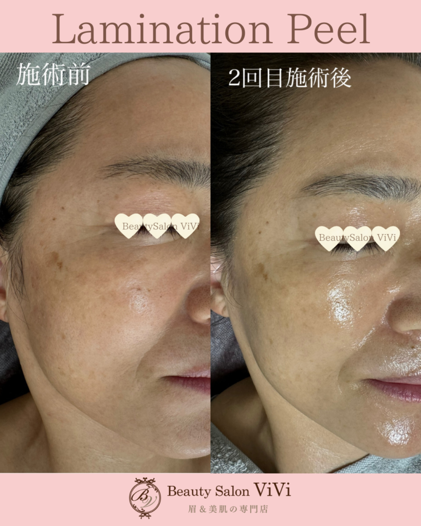 ラミネーションピール/ラミピール/剥けないピーリング/10回分/艶のある肌に！ 週末限定価格！ラミネーションピール/ラミピール/剥けない