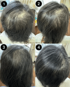 プロセルセラピーズ頭皮トリートメントの経過